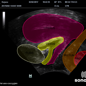 Echographie kiné : rendre visible le ressenti