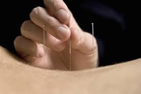Acupuncture : traitement de la douleur