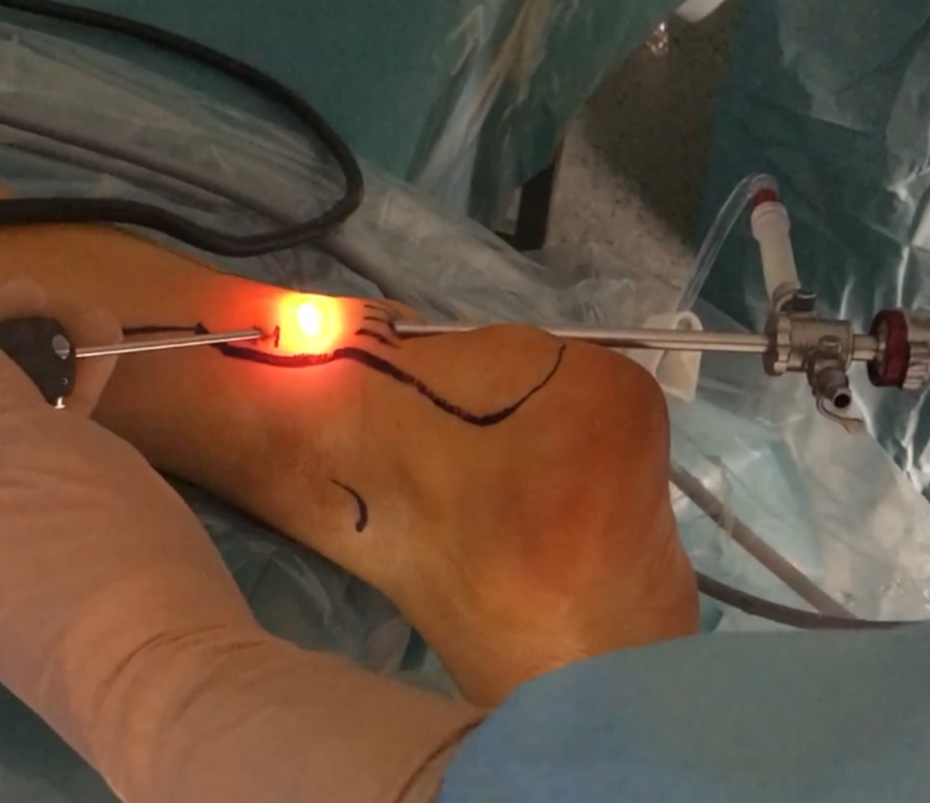 Syndrome Fissuraire Du Tendon Court Fibulaire Traitement