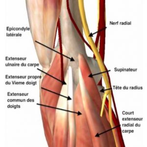 Traiter l'épicondylite par l'approche en Conterstrain Jones